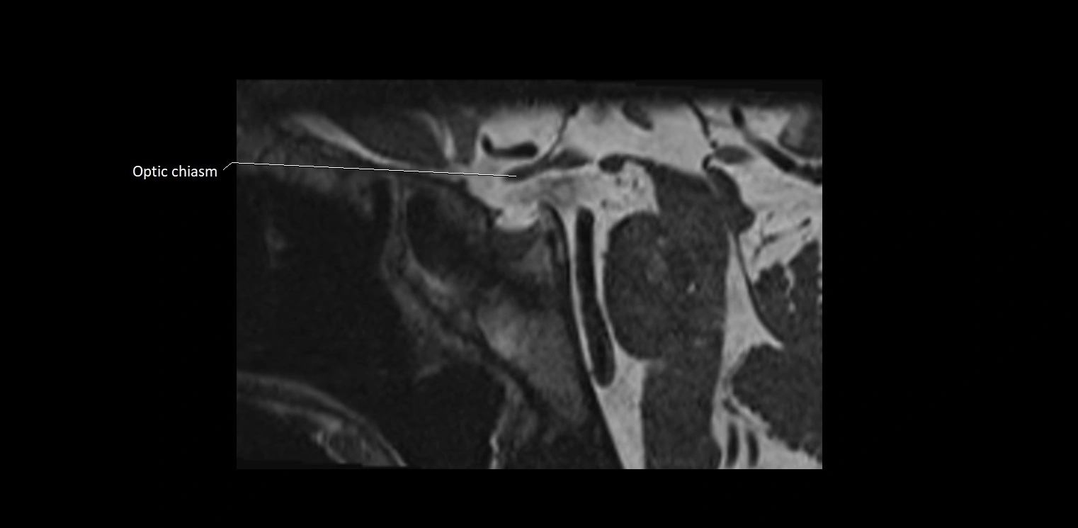 Cranial nerve sagittal anatomy MRI 3T image 33.webp